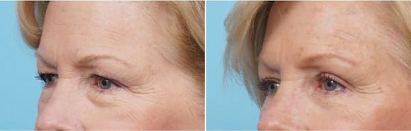 Dr. Balikian's Brow Lift Before & After Gallery - Patient 2167573 - Image 1