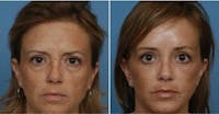 Dr. Balikian's Brow Lift Before & After Gallery - Patient 2167575 - Image 1