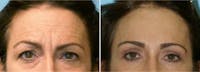 Dr. Balikian's Brow Lift Before & After Gallery - Patient 2167577 - Image 1