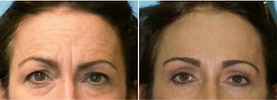 Dr. Balikian's Brow Lift Before & After Gallery - Patient 2167577 - Image 1