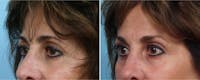 Dr. Balikian's Brow Lift Before & After Gallery - Patient 2167599 - Image 1