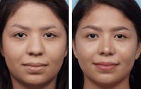 Dr. Balikian's Rhinoplasty Before & After Gallery - Patient 2167601 - Image 1