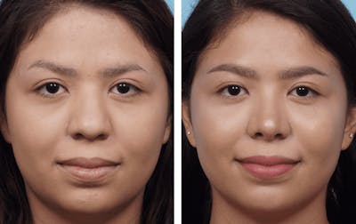 Dr. Balikian's Rhinoplasty Before & After Gallery - Patient 2167601 - Image 1