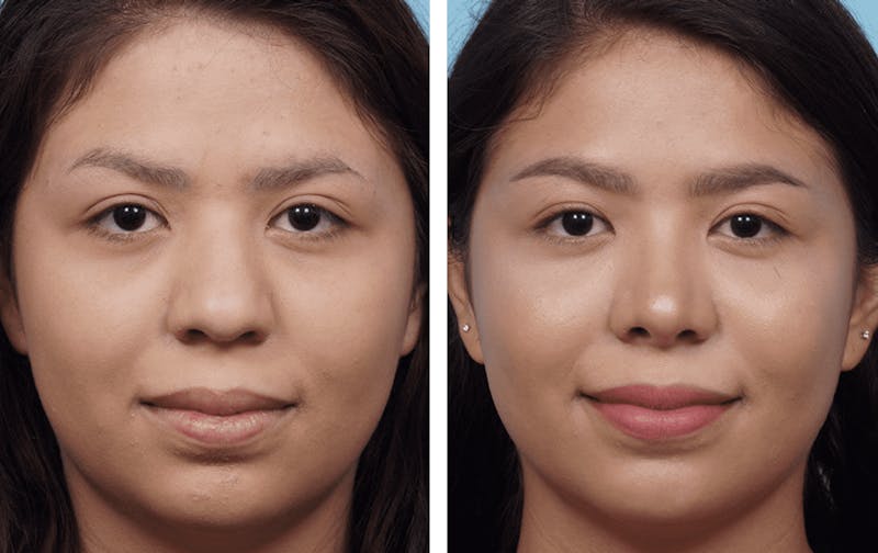 Dr. Balikian's Rhinoplasty Before & After Gallery - Patient 2167601 - Image 1