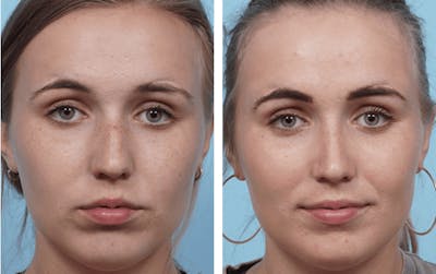 Dr. Balikian's Rhinoplasty Before & After Gallery - Patient 2167603 - Image 1