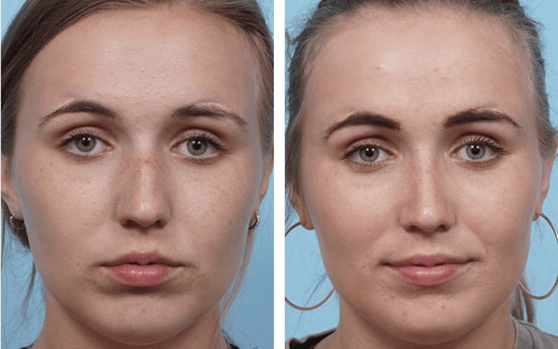 Dr. Balikian's Rhinoplasty Before & After Gallery - Patient 2167603 - Image 1