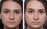 Dr. Balikian's Rhinoplasty Before & After Gallery - Patient 2167605 - Image 1