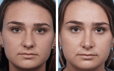 Dr. Balikian's Rhinoplasty Before & After Gallery - Patient 2167605 - Image 1