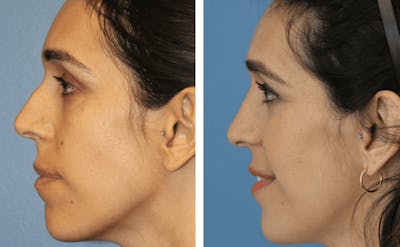 Dr. Balikian's Rhinoplasty Before & After Gallery - Patient 2167607 - Image 1
