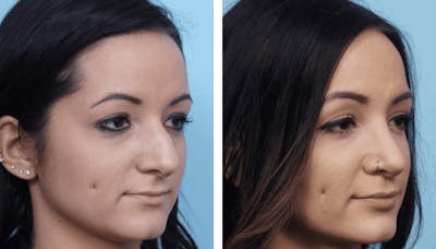 Dr. Balikian's Rhinoplasty Before & After Gallery - Patient 2167609 - Image 1
