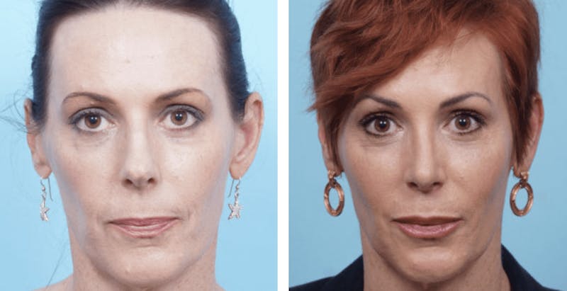 Dr. Balikian's Rhinoplasty Before & After Gallery - Patient 2167611 - Image 1