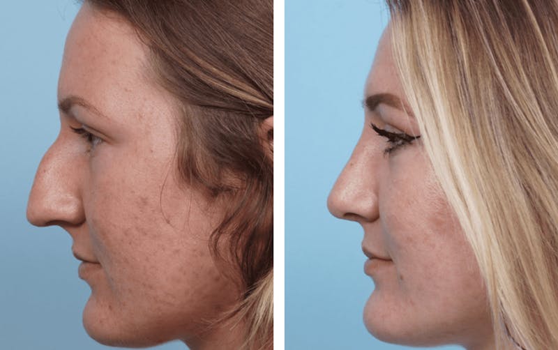 Dr. Balikian's Rhinoplasty Before & After Gallery - Patient 2167622 - Image 1