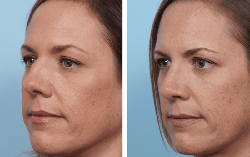 Dr. Balikian's Rhinoplasty Before & After Gallery - Patient 2167627 - Image 1