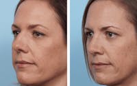 Dr. Balikian's Rhinoplasty Before & After Gallery - Patient 2167627 - Image 1
