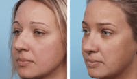 Dr. Balikian's Rhinoplasty Before & After Gallery - Patient 2167629 - Image 1