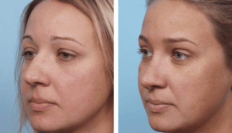 Dr. Balikian's Rhinoplasty Before & After Gallery - Patient 2167629 - Image 1