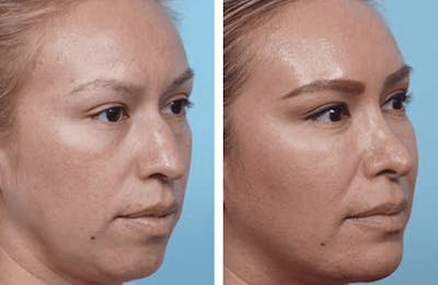 Dr. Balikian's Rhinoplasty Before & After Gallery - Patient 2167633 - Image 1