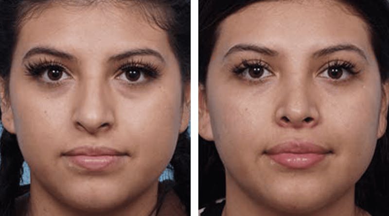 Dr. Balikian's Rhinoplasty Before & After Gallery - Patient 2167635 - Image 1