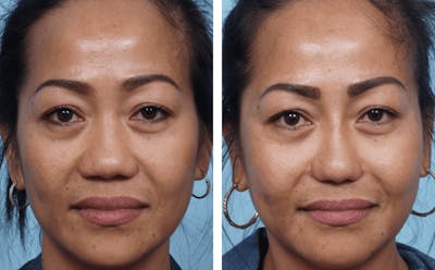Dr. Balikian's Rhinoplasty Before & After Gallery - Patient 2167637 - Image 1