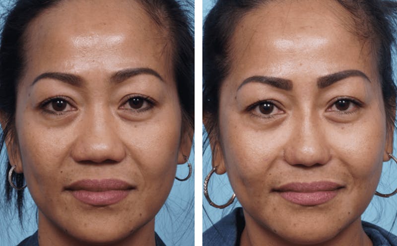 Dr. Balikian's Rhinoplasty Before & After Gallery - Patient 2167637 - Image 1