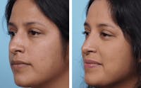 Dr. Balikian's Rhinoplasty Before & After Gallery - Patient 2167639 - Image 1