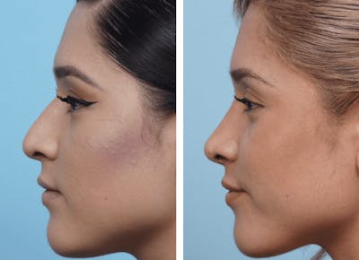 Dr. Balikian's Rhinoplasty Before & After Gallery - Patient 2167644 - Image 1