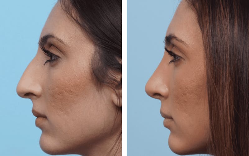 Dr. Balikian's Rhinoplasty Before & After Gallery - Patient 2167646 - Image 1