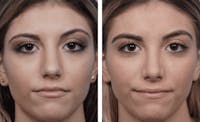 Dr. Balikian's Rhinoplasty Before & After Gallery - Patient 2167650 - Image 1