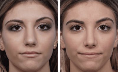 Dr. Balikian's Rhinoplasty Before & After Gallery - Patient 2167650 - Image 1