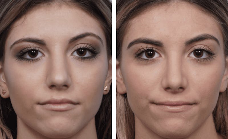 Dr. Balikian's Rhinoplasty Before & After Gallery - Patient 2167650 - Image 1