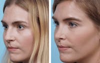Dr. Balikian's Rhinoplasty Before & After Gallery - Patient 2167655 - Image 1
