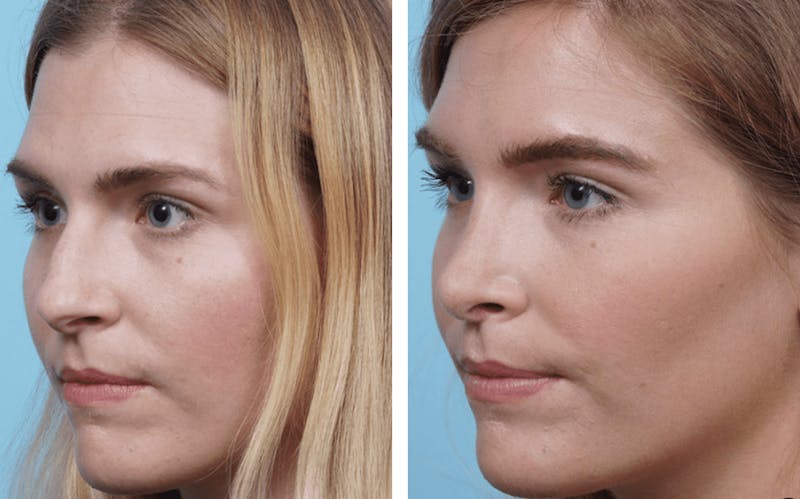 Dr. Balikian's Rhinoplasty Before & After Gallery - Patient 2167655 - Image 1