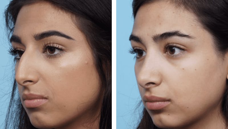 Dr. Balikian's Rhinoplasty Before & After Gallery - Patient 2167657 - Image 1