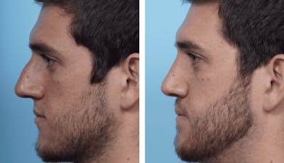 Dr. Balikian's Rhinoplasty Before & After Gallery - Patient 2167660 - Image 1