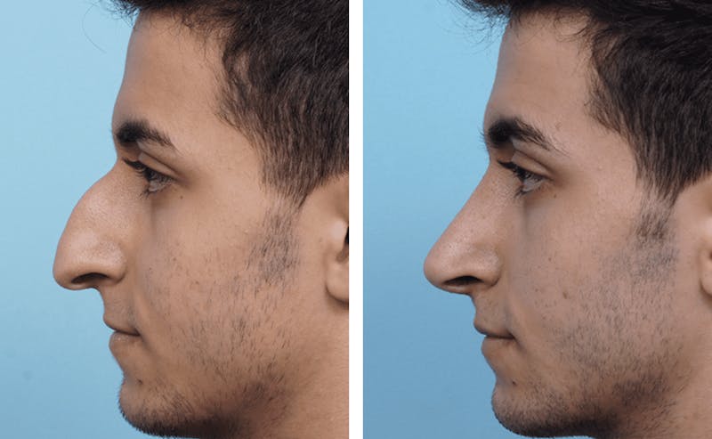 Dr. Balikian's Rhinoplasty Before & After Gallery - Patient 2167662 - Image 1