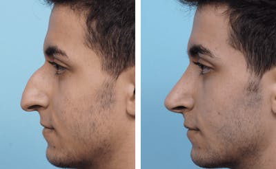Dr. Balikian's Rhinoplasty Before & After Gallery - Patient 2167662 - Image 1
