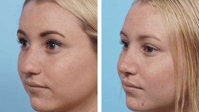 Dr. Balikian's Rhinoplasty Before & After Gallery - Patient 2167664 - Image 1