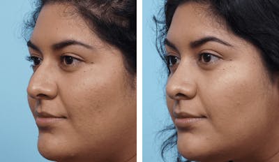 Dr. Balikian's Rhinoplasty Before & After Gallery - Patient 2167669 - Image 1