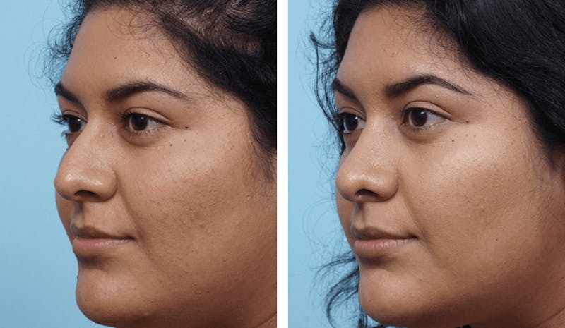 Dr. Balikian's Rhinoplasty Before & After Gallery - Patient 2167669 - Image 1