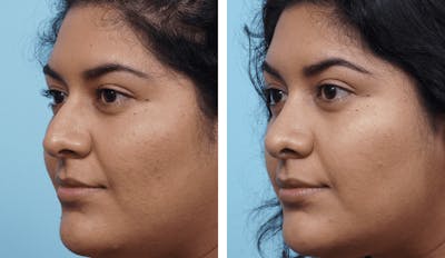 Dr. Balikian's Rhinoplasty Before & After Gallery - Patient 2167671 - Image 1