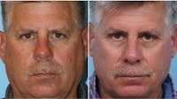 Dr. Balikian's Rhinoplasty Before & After Gallery - Patient 2167673 - Image 1