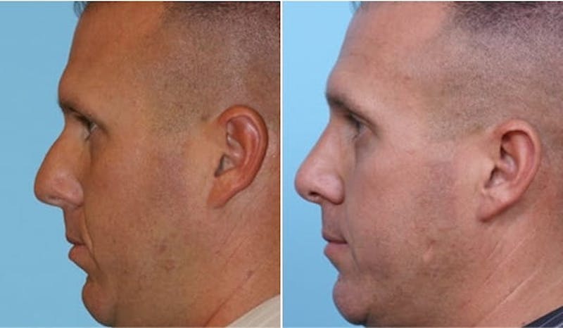 Dr. Balikian's Rhinoplasty Before & After Gallery - Patient 2167676 - Image 1