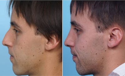 Dr. Balikian's Rhinoplasty Before & After Gallery - Patient 2167679 - Image 1