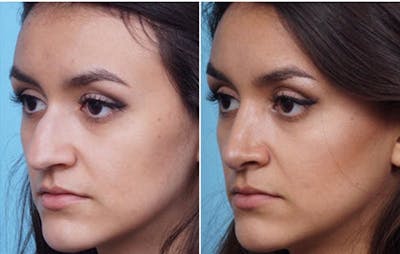 Dr. Balikian's Rhinoplasty Before & After Gallery - Patient 2167681 - Image 1
