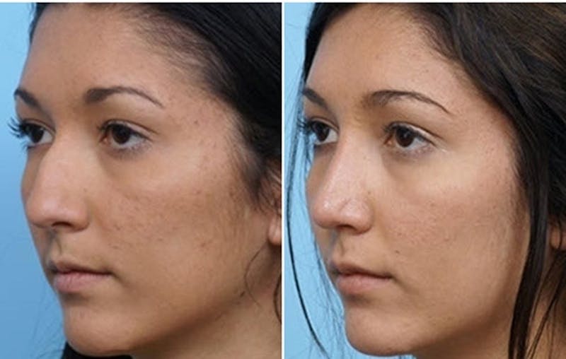 Dr. Balikian's Rhinoplasty Before & After Gallery - Patient 2167685 - Image 1