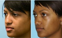 Dr. Balikian's Rhinoplasty Before & After Gallery - Patient 2167687 - Image 1