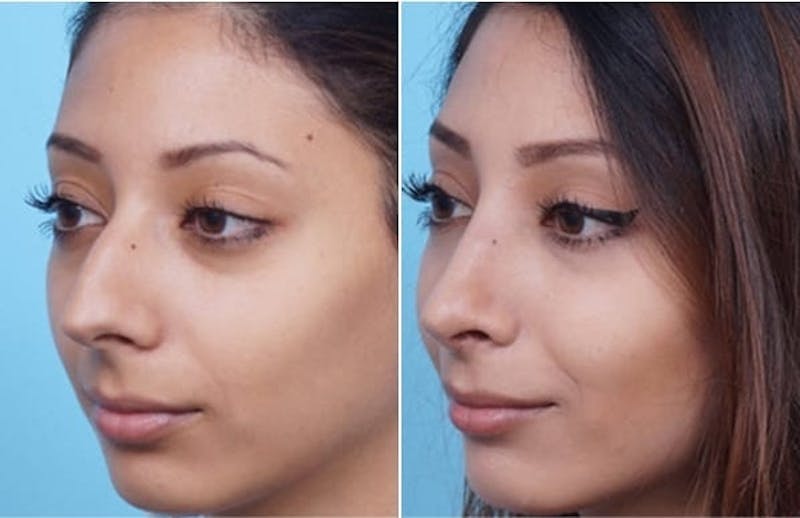 Dr. Balikian's Rhinoplasty Before & After Gallery - Patient 2167689 - Image 1