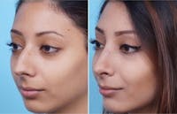 Dr. Balikian's Rhinoplasty Before & After Gallery - Patient 2167689 - Image 1