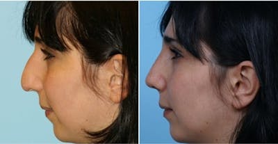 Dr. Balikian's Rhinoplasty Before & After Gallery - Patient 2167691 - Image 1