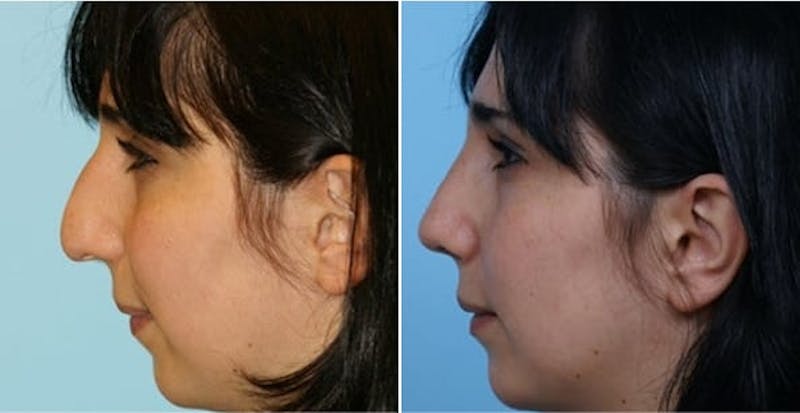 Dr. Balikian's Rhinoplasty Before & After Gallery - Patient 2167691 - Image 1